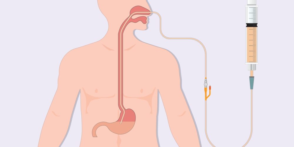Nasogastric,Tube,Feeding,(ng),Is,A,Thin,Flexible,Tube,Inserted Nasogastric,Tube,Feeding,(ng),Is,A,Thin,Flexible,Tube,Inserted