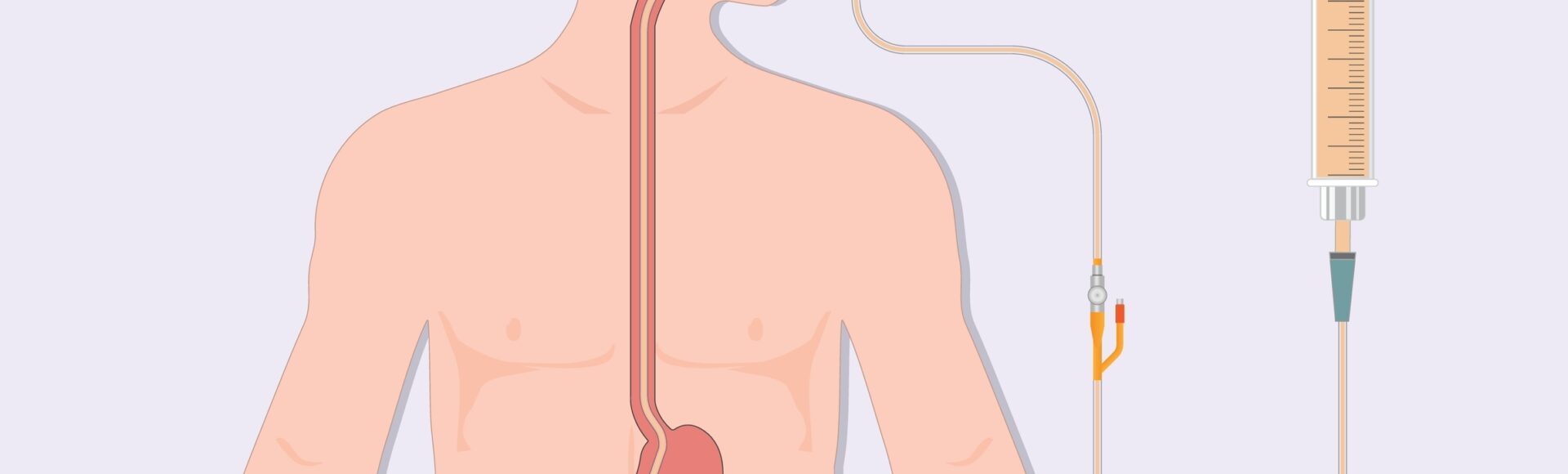 Nasogastric,Tube,Feeding,(ng),Is,A,Thin,Flexible,Tube,Inserted Nasogastric,Tube,Feeding,(ng),Is,A,Thin,Flexible,Tube,Inserted